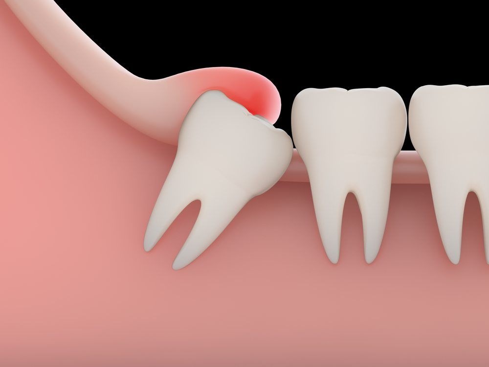 Кариес зуба мудрости: причины появления, симптомы